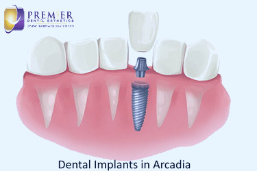 Dental Implant Cost | How much are dental implants? (2023) | Arcadia, CA |  Premier Dental Esthetics